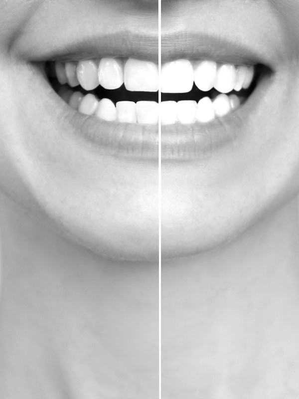 blanchiment et facette